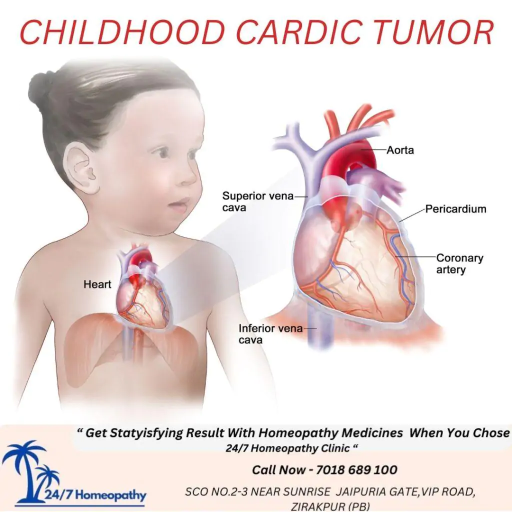CHILDHOOD CARDIC TUMOR homeopathy treatment in zirakpur