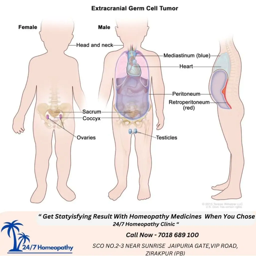 Extra gonadal germ cell tumor