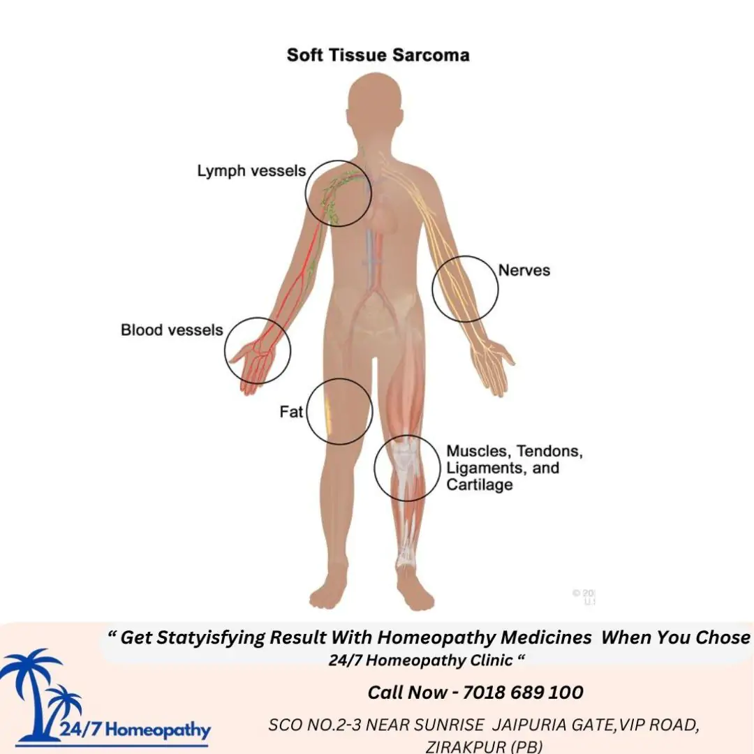 SARCOMA HOMOEOPATHIC MEDICINE in zirakpur