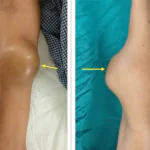EWING SARCOMA