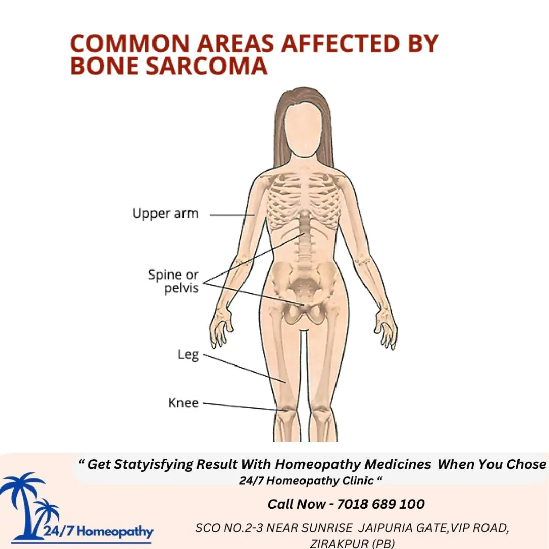 SARCOMA HOMOEOPATHIC MEDICINE