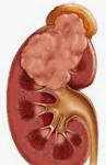 KIDNEY CANCER