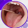 OROPHARYNGEAL CANCER