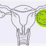OVARIAN CANCER