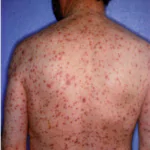 CHRONIC LYMPHOCYTIC LEUKEMIA