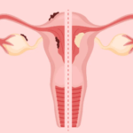 endometrial cancer homeopathy treatment India