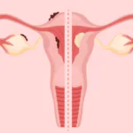 endometrial cancer homeopathy treatment India