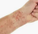 LEUKEMIA homeopathy treatment India