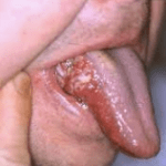 LIP AND ORAL CAVITY CANCER