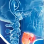 MYELOPROFIRATIVE NEOPLASMS HOMOEOPATHIC TREATMENT