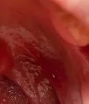 HYPOPHARYNGEAL CANCER homeopathy treatment