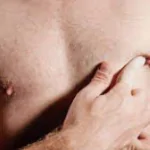 MALE BREAST CANCER