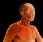 MEATSTATSIC SQUAMOUS NECK CANCER WITH OCCULT PRIMARY