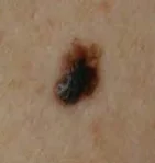 MELANOMA homeopathy treatment India
