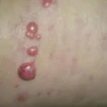 MERKEL CELL CARCINOMA homeopathy treatment India
