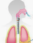 MESOTHELIOMA (MALIGNANT) homeopathy treatment India