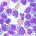 acute myeloid leukemia