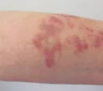 KAPOSI SARCOMA homeopathy treatment in zirakpur