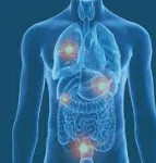 METASTATIC CANCER homeopathy treatment India