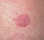 Mycosis Fungoides homeopathy treatment India