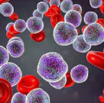 ACUTE LYMPHOBLASTIC LEUKEMIA