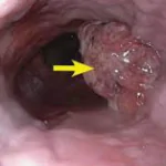 ESOPHAGEAL CANCER homeopathy treatment India
