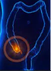 APPENDIX CANCER-Gastrointestinal neuroendocrine tumor