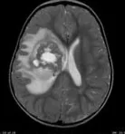 ATYPICAL/ RHABDOID TUMOR homeopathy treatment India