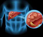 CHOLANGIOCARCINOMA / BILE DUCT CANCER