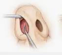CHORDOMAS homeopathy treatment India