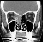 ESTHESIONEUROBLASTOMA homeopathy treatment India