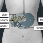 bile duct cancer treatment