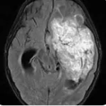 EMBRYONAL TUMORS Homeopathy Treatment