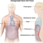 EXTRA GONADAL GERM CELL TUMOUR