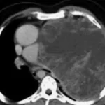 EXTRAGONADAL GERM CELL TUMORS