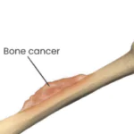 bone cancer