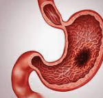 GASTRIC CANCER​ homeopathy treatment