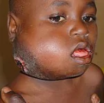 BURKITT LYMPHOMA -- image by Wikipedia
