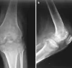 UNDIFFERENTIATED PLEMORPHIC SARCOMA OF BONES