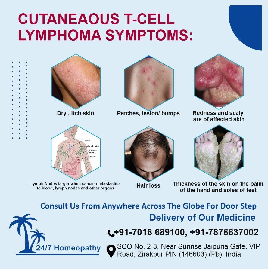 Cutaneaous T- Cell Lymphoma symptoms homeopathy treatment