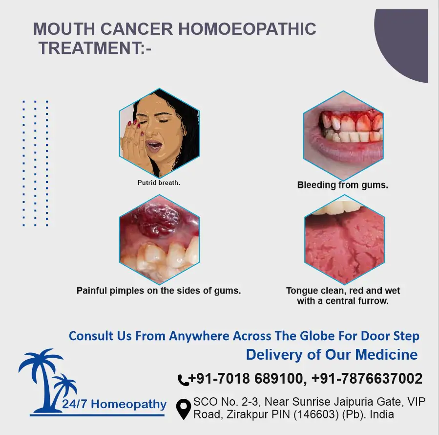 Mouth cancer homeopathy treatment